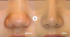 Bulbous Nose Rhinoplasty, Nose Structure, Nose Rhinoplasty, Plastic Surgery Korea, Upturned Nose, Bulbous Nose, Hooked Nose, Parts Of The Nose, Nose Types