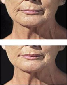 AngelLift - Clinically Proven Wrinkle Reduction with DermaStrips Groom Accessories, Wrinkle Reduction, Beauty Devices, Beauty Treatments, Wrinkle Free