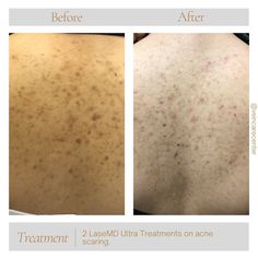 Wow Me Wednesday! This before and after is after 2 LaseMD Ultra treatments on this patient’s back who was struggling with pigment changes from “bacne”. You can see the pigmented areas are lighter and the skin texture is becoming more smooth! #yourveincarecenter #laserspecialist #limaohio #northwestohio #bacne #acnescars #scartreatment #smoothskin @lutronic_us @lutronic Lima Ohio, Skin Texture, The Skin, Smooth Skin, Texture, Canning, Skin, Quick Saves