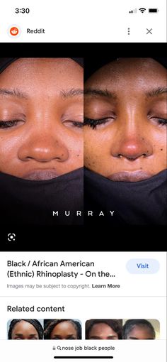 Pretty Lip Fillers, Rhinoplasty Before And After Black Women, Black Women Nose Job, Nose Job Before And After Black, Nose Jobs Black Women, Rhinoplasty Black Women, Thick Skin Nose Job, Flat Wide Nose, Flat Button Nose