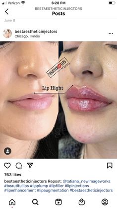 Lip Flip Before And After, Armonizacion Facial, Dermal Fillers Lips, Russian Lips, Lip Types