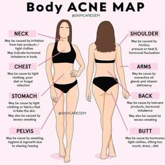 Acne Chart Causes Of, Body Acne Map, Acne Map, Skin Advice, Body Map, Hygiene Tips