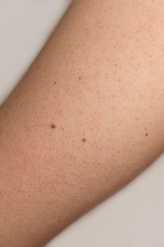 Keratosis Pilaris Red Dots On Legs Skin, Red Dots On Skin, Black Dots On Face, Skin Problems Face, Red Spots On Legs, Dots On Face, Spots On Legs, Nail Problems, Face Pores