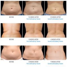 Diy Coolsculpting, Coolsculpting Before And After, Skin Removal Surgery, Wish I Was Pretty, Home Art Ideas, Beauty Therapy Room, Medical Procedures, Excess Skin