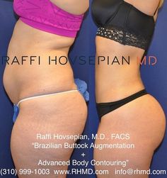 Side view. This patient underwent Dr. Raffi Hovsepian's Advanced Liposuction and Body Transformation procedure with Buttock Sculpture. The… Md Aesthetic, Brazilian Buttlift, Ideal Aesthetic, Mommy Makeover, Fitness Motivation Pictures, Body Modification, Body Motivation, Tummy Tucks, Body Modifications