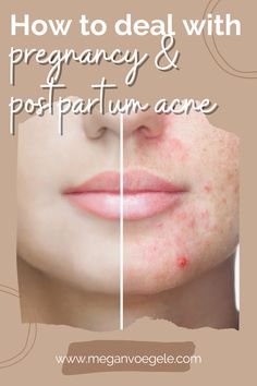 Postpartum Acne, Back Acne Remedies, Regrow Hair Naturally, Chest Acne, Nose Cleaner, Bad Acne