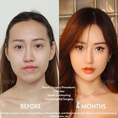 #plasticsurgery #plasticsurgerygonewrong #beforeafter #celebritiesbeforeafter #hollywoodstars #bignosesurgery #surgery #facesurgery #vlinesurgery #koreanplasticsurgery #kpopplasticsurgery #nosejob #jawreductionsurgery #eyesurgery #cheekfillers #rhinoplasty #facelift #plasticsurgeryfails #expensiveplasticsurgery Jaw Surgery