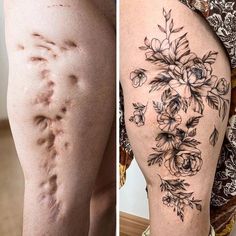 two pictures side by side, one shows the scar on someone's leg and the other shows what they are doing