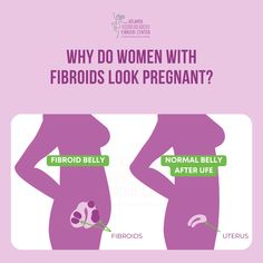 fibroids, uterus, UFE Fibroid Belly Before And After, Bloated Belly, Women's Health, My Story, Womens Health, Weight Gain, Every Woman, A Woman