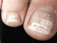 White Patches On Toenails, White Spots On Toenails, White Spots On Nails, Nail Discoloration, Toenail Fungus Remedies, Nail Care Tips, Toenail Polish, Ingrown Toe Nail, Toenail Fungus