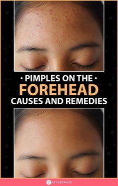 How To Get Rid Of Forehead Acne - 9 Home Remedies To Try Get Rid Of Forehead Acne, Prevent Pimples, Cold Sore, Double Chin, Wooden Sculpture