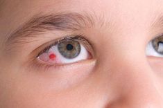 How to treat eye infection naturally and effectively in reducing the pain and swelling? Here are some easy to follow tips after consulting the doctor. Remedy For Sinus Congestion, Home Remedies For Sinus, Throat Infection, Sinus Congestion, Light Sensitivity, Eye Surgery, Sinus Infection, Stomach Ache