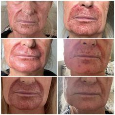 Plasma Pen Fibroblasting For Wrinkles, Sagging, and Scars Plasma Pen Before After Under Eye, Plasma Facial, Facelift Procedure, Facial Procedure, Celebrity Skin Care