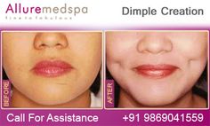 Dimple creation Surgery in Mumbai,India.Expert Cosmetic Surgeon Dr.Milan Doshi offer to enhance your looks by creating dimple on cheek or face with half hour surgery.The ideal way is to visit alluremedspa.in to get procedure pricing, doctor, patient reviews & cosmetic surgical clinics in Mumbai,India. Doctor Patient, Body Modification, Web Design Services, Mumbai India, Med Spa, Body Modifications, Cosmetic Surgery, Girl Blog