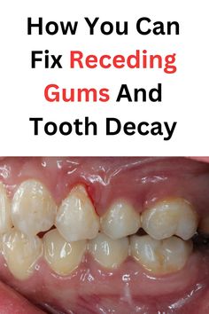 How You Can Fix Receding Gums And Tooth Decay Fix Receding Gums, Diy Spices, Melt In Your Mouth