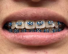 Blue Braces Teeth, Navy Blue Braces Teeth, Periwinkle Braces, Braces Aesthetic Colors, Dark Blue Braces, Light Blue Braces