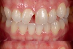 before and after treatment with dental veneers on four front teeth Front Teeth, Dental Veneers, Quick Saves