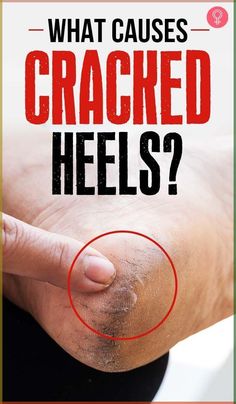 What Causes Cracked Heels? The causes of crack in foot heels may may be due to several reasons. Keep reading to find out the reasons. #heels #crackedheels #beauty #beautytips #skincare #skincaretips Home Remedy For Cracking Heels, Feet Cracks Remedies, How To Get Rid Of Cracked Heels, How To Heal Cracked Heels, Dry Heels How To Get Rid Of, Cracked Heels Remedy Overnight, Cracked Finger Tips, Cracked Heels Remedy, Cracked Heel Remedy