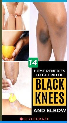 Dark Elbows And Knees, Dark Knees And Elbows, Hyperpigmentation Remedies, Eye Health Remedies, Eye Medicine, Puffy Eyes Remedy, Dark Knees, Dark Elbows, Yoga Information