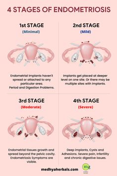 4 Stages of Endometriosis Low Estrogen Symptoms, دورة شهرية, Healthy Remedies, Low Estrogen, Ayurveda