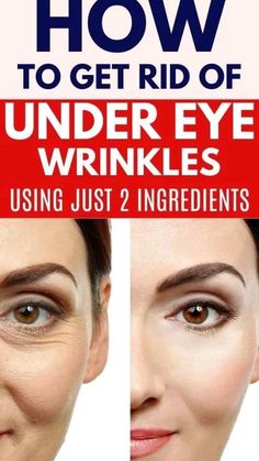 Natural Eye Wrinkle Remedies, Wrinkles Under Eyes Remedies, Wrinkle Under Eyes Remedies, How To Remove Under Eye Wrinkles, How To Remove Eye Wrinkles, Wrinkles Under Eyes Get Rid Of, Wrinkles Around The Eyes, How To Remove Wrinkles Under Eyes, Eyes Wrinkles Remedies