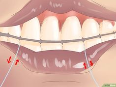 How to Stop Bleeding Gums, Gingivitis, Periodontitis: 11 Steps Home Gum, Teeth Remedies, Tartar Removal, Get Whiter Teeth, Nursing Tips