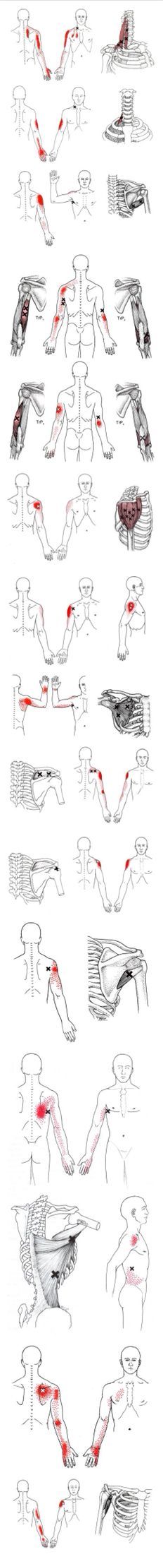 Massage Pressure Points, Medical Massage, Trigger Point Massage, Sports Therapy, Back Pain Remedies, Spine Surgery