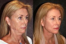 Skin Fillers, Under Eye Fillers, Fat Grafting