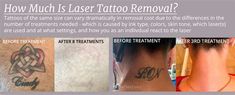 the before and after pictures of laser tattoo removal