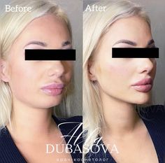 Face Plastic Surgery, Nose Surgery Rhinoplasty, Cosmetic Fillers, Chin Implant, Rhinoplasty Nose Jobs, Face Fillers, Botox Lips, Botox Face, Cheek Fillers