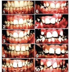 an image of teeth showing different types of teeth