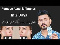 #bestwhiteningcreaminpakistan#removepimples#bestylingPimples, also called acne, occur when your skin’s oil glands are overactive and pores become inflamed. S... Clear Pimples, Clear Skin Remedies, Blind Pimple, Pimples Under The Skin, Nose Picking