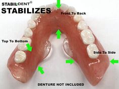 Diy Dentures, Dental Impression Material, Tooth Pulled, Temporary Tooth