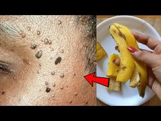 Skin Tags On Face, Remove Skin Tags, Warts On Face, Remove Skin Tags Naturally, Onion Skin, Tag Remover, Mole Removal, Skin Tags, Banana Peel