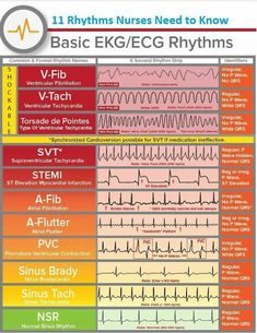 Ekg Rhythms, Emt Study, Medical Terminology Study, Ekg Interpretation, Nursing Mnemonics, Nursing Student Tips