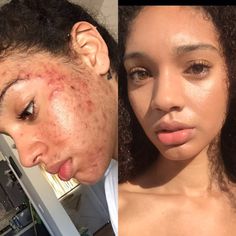 Acne Skincare Routine, Natural Acne, Going Viral, Skin Complexion, Acne Skin, Skin Care Acne, Skin Care Women, Better Skin, Beauty Secrets