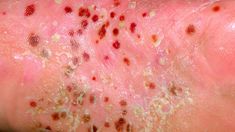 Skin Symptoms, Scaly Skin, Red Patch, Lighter Skin, Light Skin, Different Types, Signs, Skin