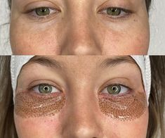 Fibroblast Before And After Eyes, Fibroblast Before And After, Gentle Face Wash