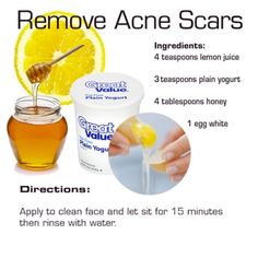 Diy Skin Remedies, Acne Scar Diy, Home Remedies For Acne, Diy Skin Care Recipes, Healthier Skin, Skin Remedies, How To Get Rid Of Acne