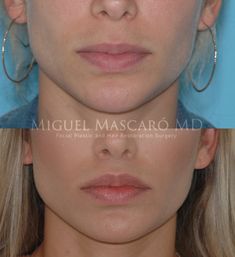 Lip Lift Surgery, Face Plastic Surgery, Nose Surgery Rhinoplasty, Lip Lift, Facial Fillers, Facial Contouring, Nose Surgery, Facial Plastic Surgery, Lip Enhancement