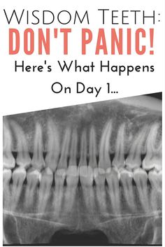 Wisdom Teeth: Don't Panic! Here's What Happens On Day 1 | www.thegingermarieblog.com Wisdom Teeth Removal Recovery, Wisdom Teeth Video, Wisdom Teeth Pain Relief, Wisdom Teeth Pain, Tooth Pain Relief, After Wisdom Teeth Removal