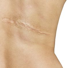 the back of a woman's stomach showing her scar