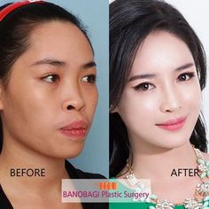 Email English, Teeth Correction, Plastic Surgery Photos