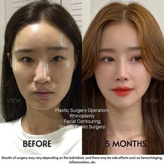 Kpop Plastic Surgery, Jaw Reduction Surgery, V Line Surgery, Plastic Surgery Fail, Korean Plastic Surgery, Plastic Surgery Gone Wrong, Face Surgery, Body Makeover, Cheek Fillers