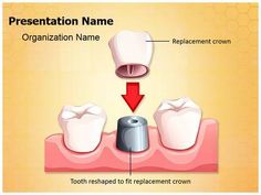 "Check out MedicPresents.com's free Dental Crown Procedure Medical PowerPoint Template now for your upcoming Dental Crown Procedure PowerPoint Presentations. #Drawing #DentalImplant #Filling #Procedure #Restoration #Nerves #Gum #Tooth #Abscess #Cavity #Gutta-Percha #Mandible #Edentulism #Cement #BdentalCrownProcedure #Porcelain #Implant #Infected #Fabricate #Graphic #Root #Post #Dentist #Plugger #Cemented #DentalImpression #Crown #Dental #BloodVesselsentistry #Replace #Process #Maxilla #Dentin Dental Crown Procedure, Tooth Ache Relief, Dental Restoration, Remedies For Tooth Ache, Discolored Teeth, Restorative Dentistry, Presentation Backgrounds, Dental Center, Dental Crowns