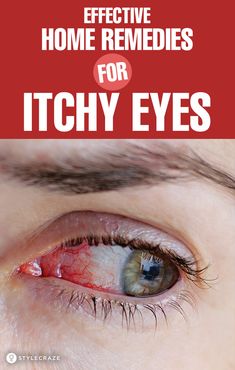 Remedies For Itchy Eyes, Allergy Eyes, Dry Eyes Causes, Irritated Eye, Itchy Eyes, Sore Eyes, Eyes Problems, Dry Eyes