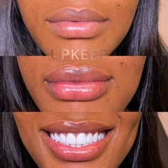 #upkeepmedspa #upkeep #beauty #medspa #nyc #newyorkcity #injections #filler #lipsnyc #botox #aesthetics #aesthetician #womenownedbusiness  #lipinjections #lipplump #cheekfiller #jawlinefiller #dallasmedspa #dallas #lipinjections Lip Filler Aesthetic, Lip Flip, Cute Braces Colors, Pretty Teeth, Medical Aesthetician, Lips Inspiration, Face Glow, Lip Blush