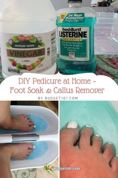 Callus Remover Diy, Diy Pedicure At Home, Homemade Pedicure, Home Foot Soak, Homemade Foot Soaks, Pedicure Soak, Listerine Foot Soak, Callous Remover