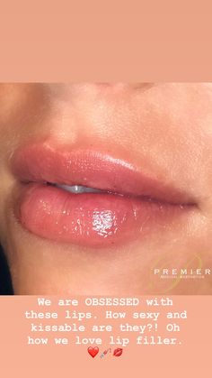 Natural Filler, Lip Goals, Russian Lips, Lip Model, Aesthetic Dermatology, Small Lips