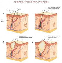 Acne is a disorder of the pilosebaceous units in the skin. These are found most abundantly in the skin over the face, the upper chest, and the back. They are responsible for the growth of skin hair in addition to the lubrication of the skin. Whiteheads Remedy, Skin Anatomy, Integumentary System, Health Medicine, Acne Serum